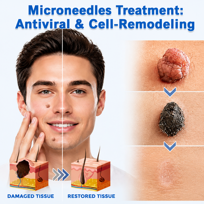 ODALIT® 2-in-1 Microneedle & Hydrocolloid Patch🍀| Removes Raised Moles, Acne, Flat Warts & Skin Tags | Helps Improve Wrinkles, Scars & Blemishes | Invisible Patches for Face & Body